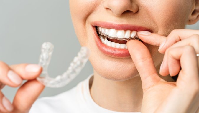 Advantages of removable appliances in orthodontics